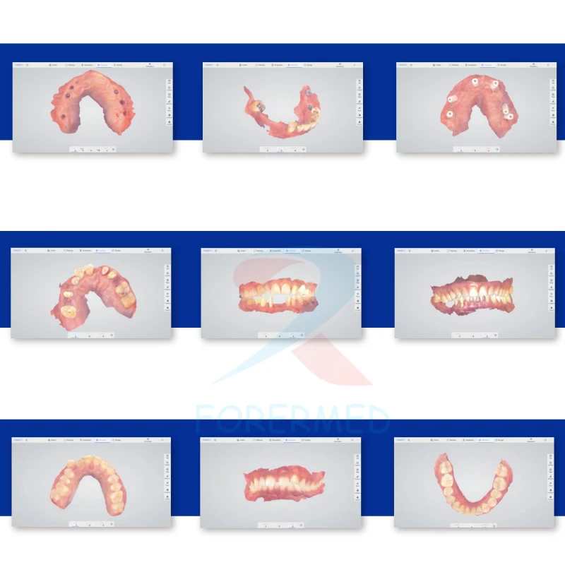3D Intra Oral Scanner 3D Intra Oral Scanner